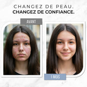 Rituel Complet Anti-Acné - Peau Nette & Confiance Retrouvée