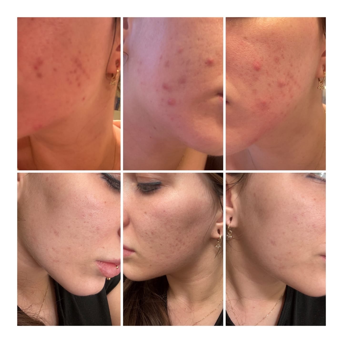 avis-acne-1.jpg