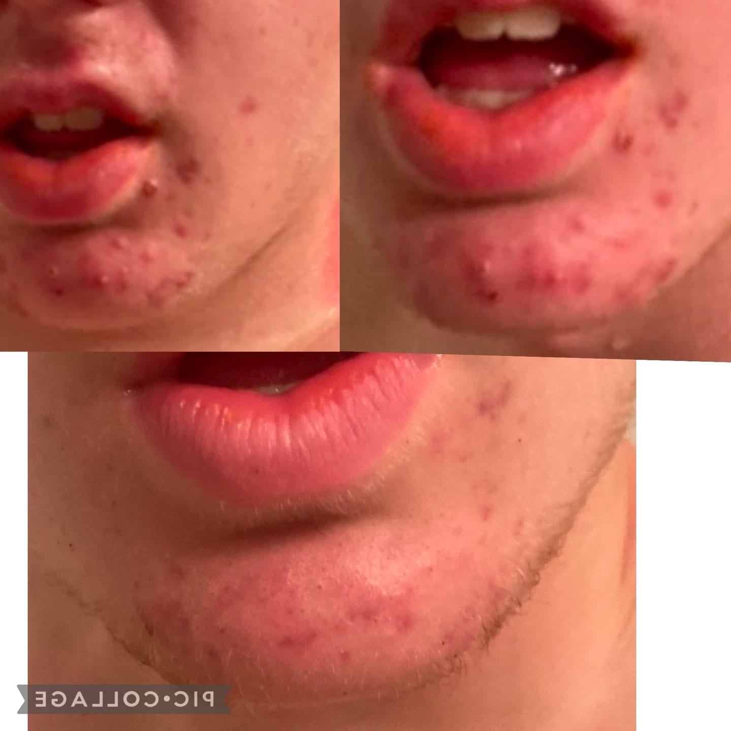 avis-acne-2.jpg