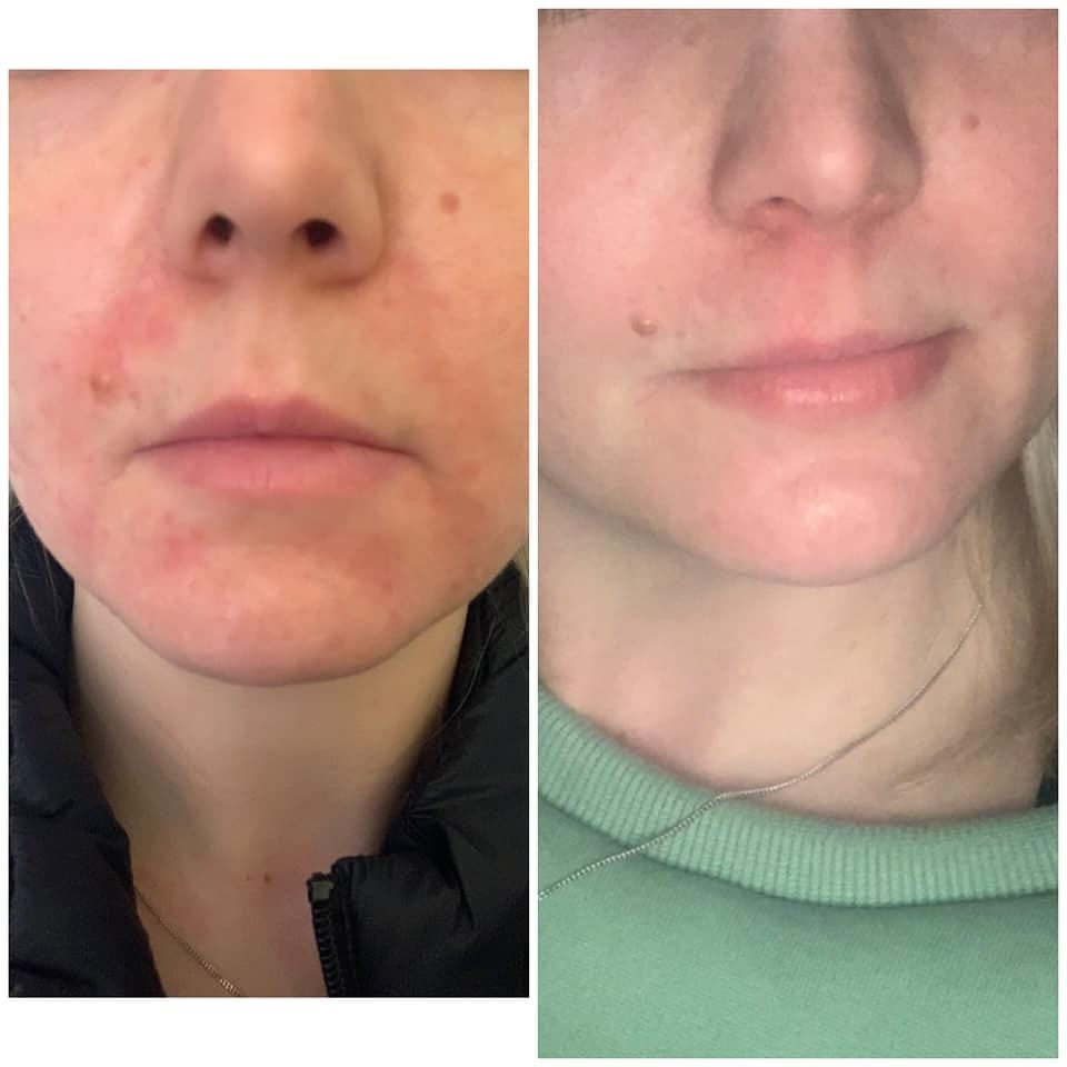 avis-acne-3.jpg