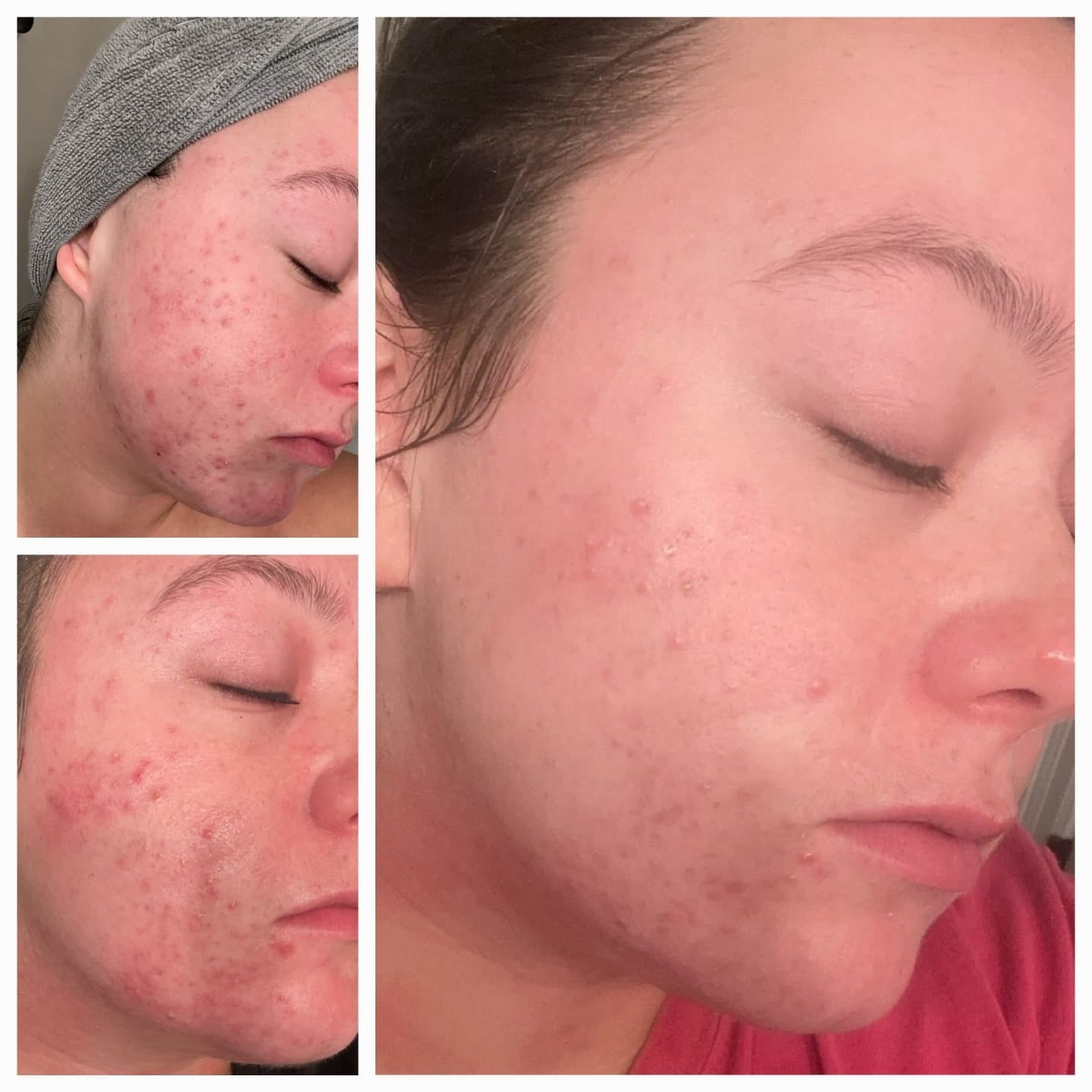 avis-acne-4.jpg