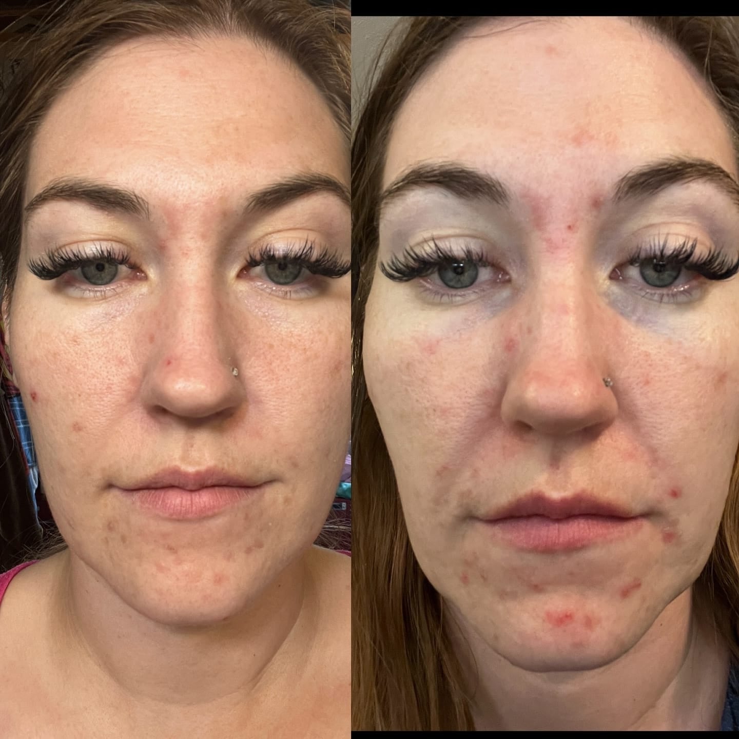 avis-acne-6.jpg